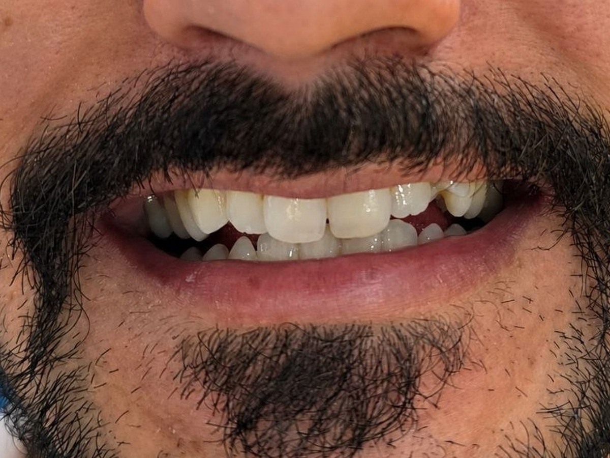 Clear Aligners before treatment