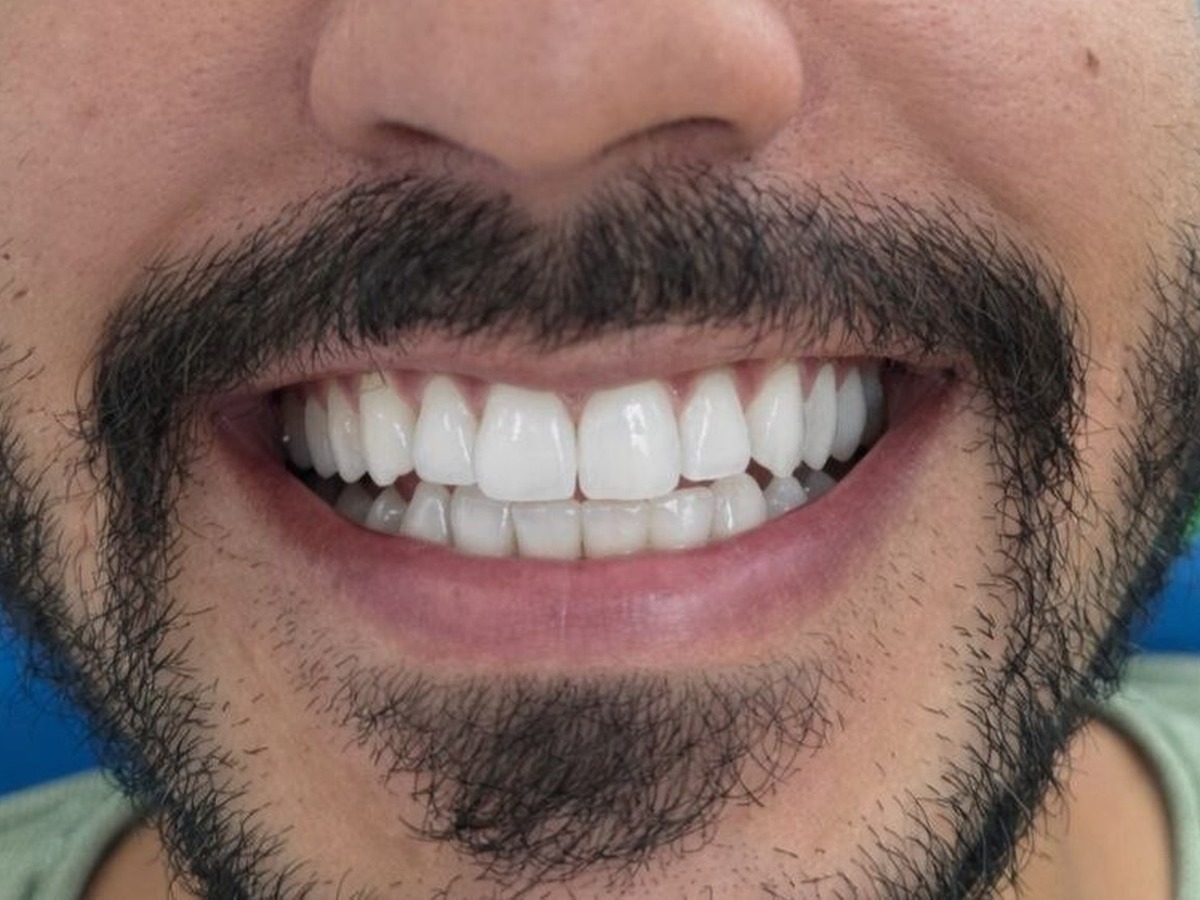 Clear Aligners after treatment
